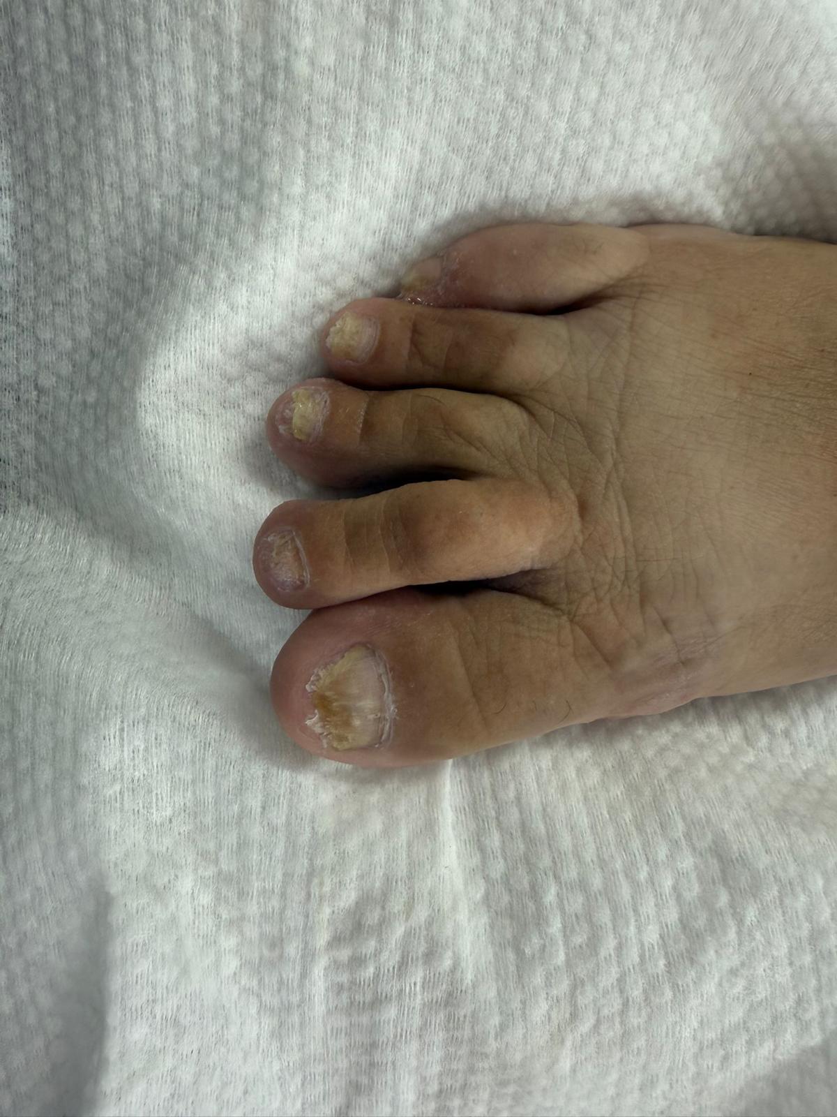 פדיקור רפואי לפני ואחרי